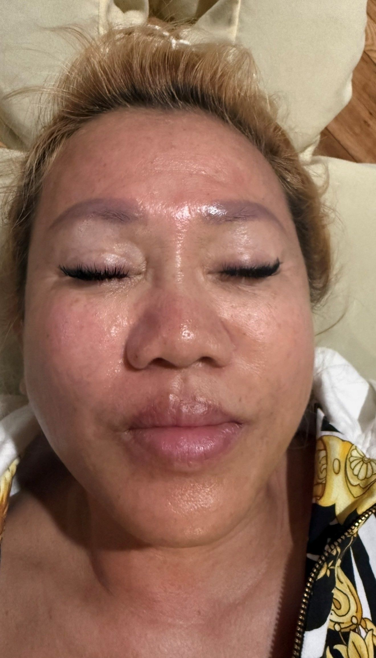 Before 55-Year Old Woman First Microneedling Treatment