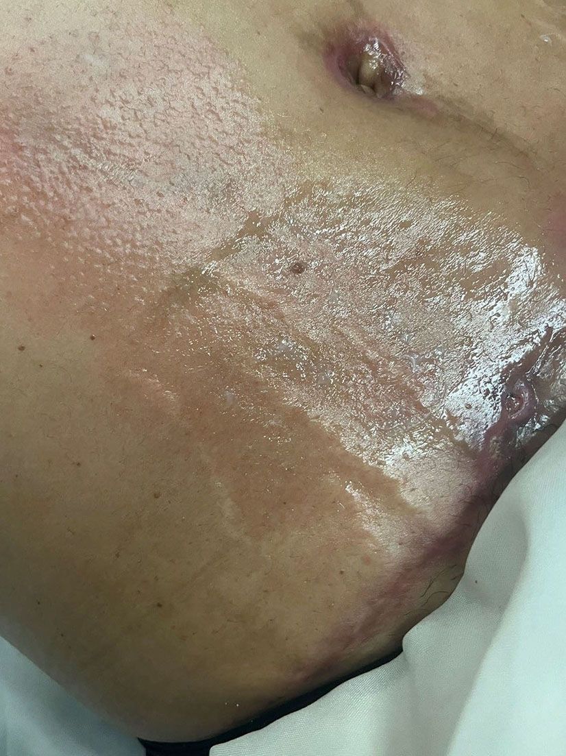 Close-up of human abdomen, skin glistening with possible liquid, with a small wound and surrounding redness.