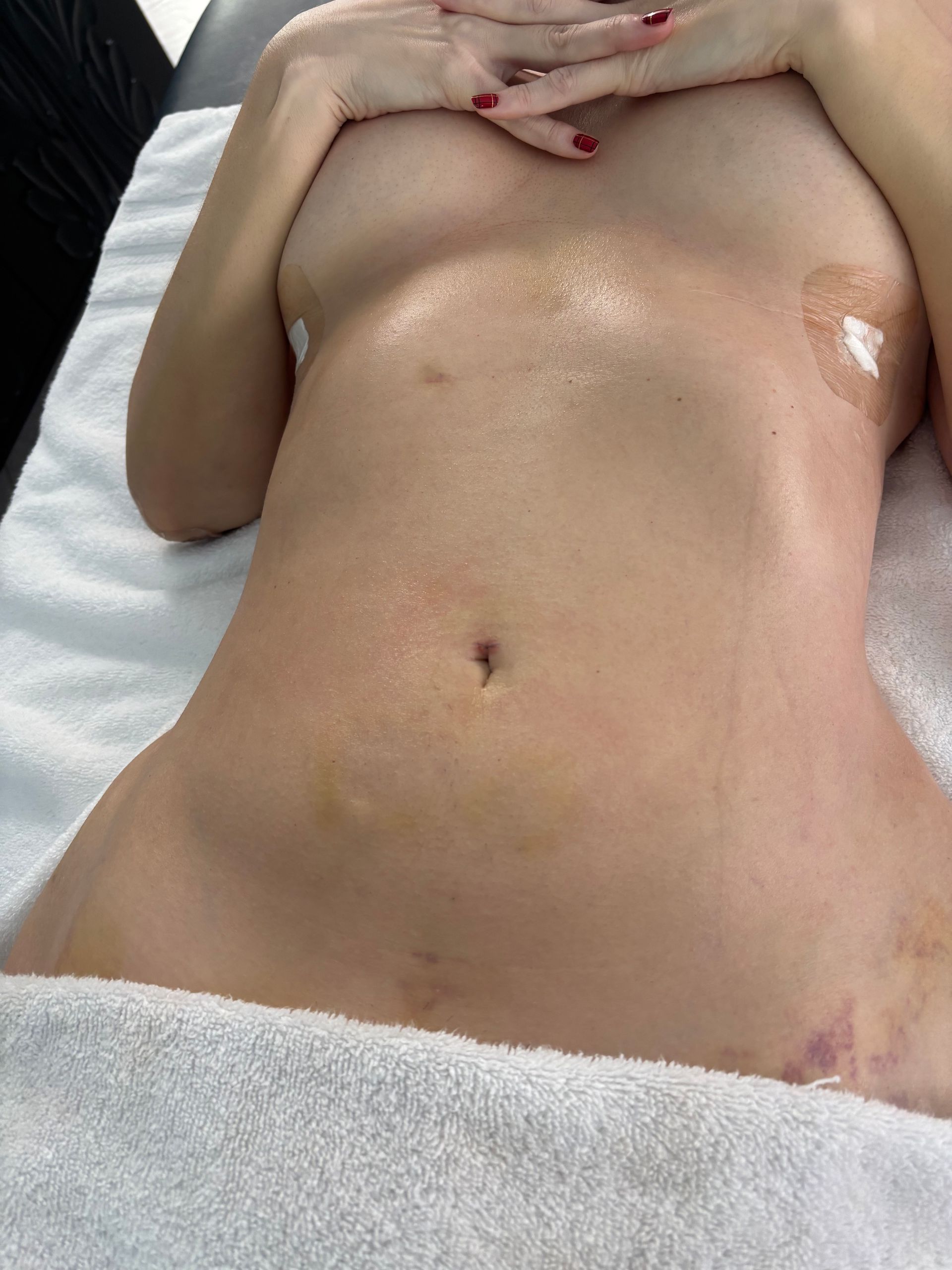 Before 40 Year Old Woman Renuvion Skin Tightening with Lipo Suction