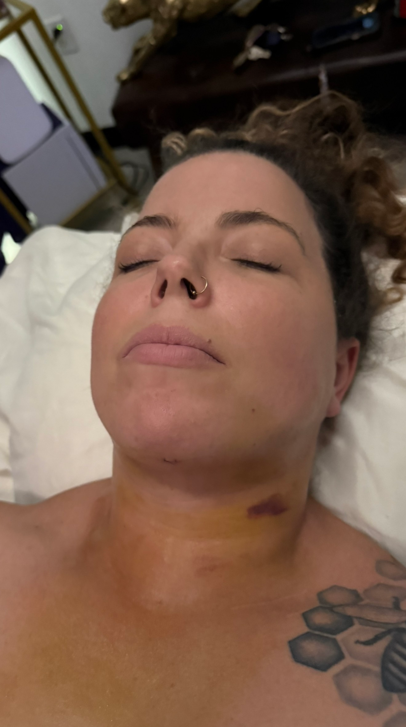 Before 30 Year Old woman- Lymphatic Drainage post Chin Liposuction
