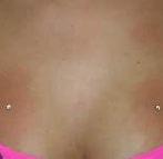 dermal