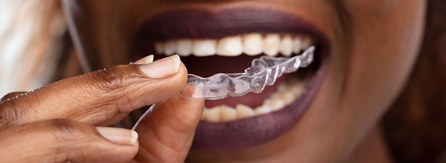 A person fitting a clear aligner onto their teeth, close-up of smiling mouth