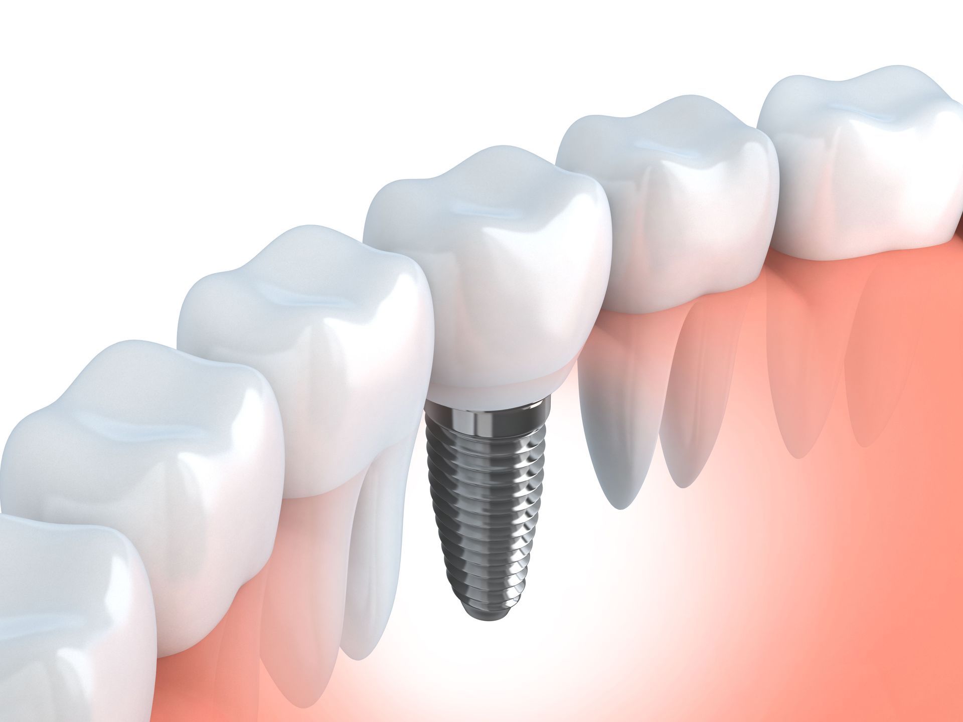 implant dentists