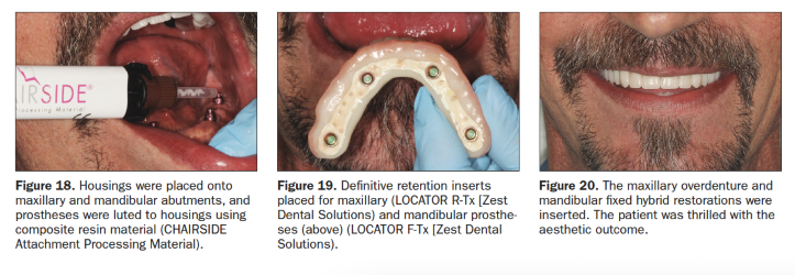 A picture of a man 's mouth with a dental implant in it