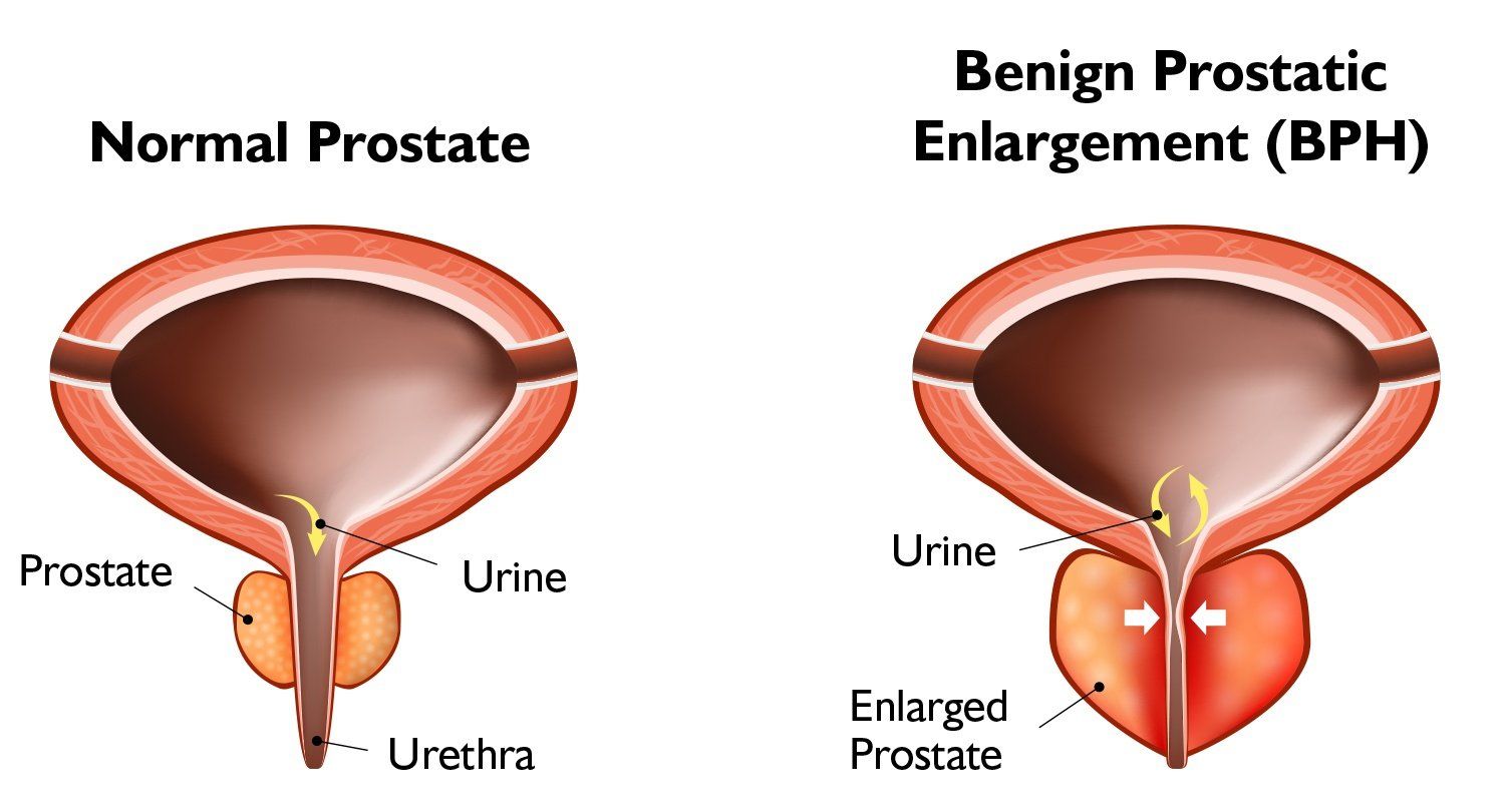 Prostate Model