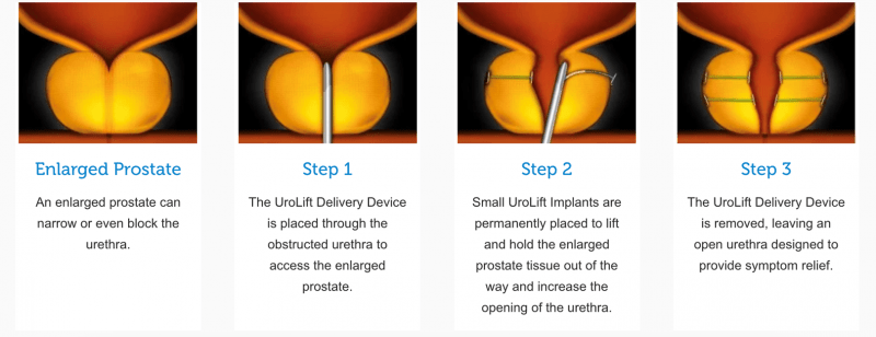 Urolift Procedure