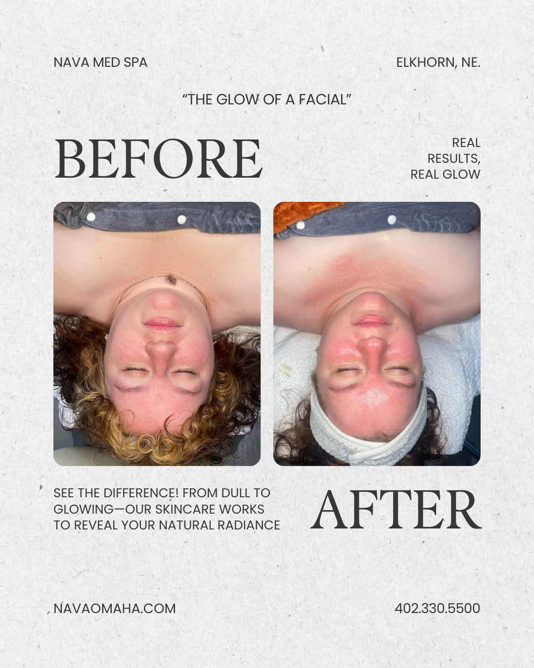 Before and after facial treatment photos: Face with more color before treatment, and less after. Naya Med Spa.