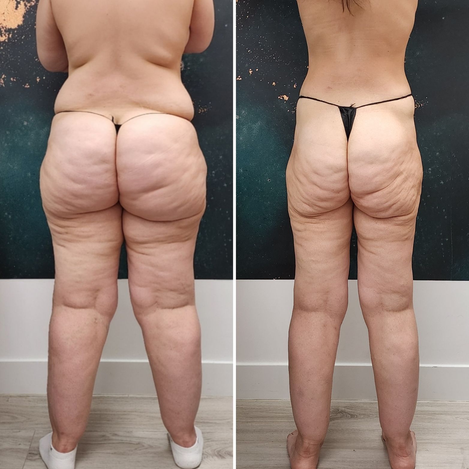 Two rear-view photos side by side showing a person in black underwear before and after weight loss.