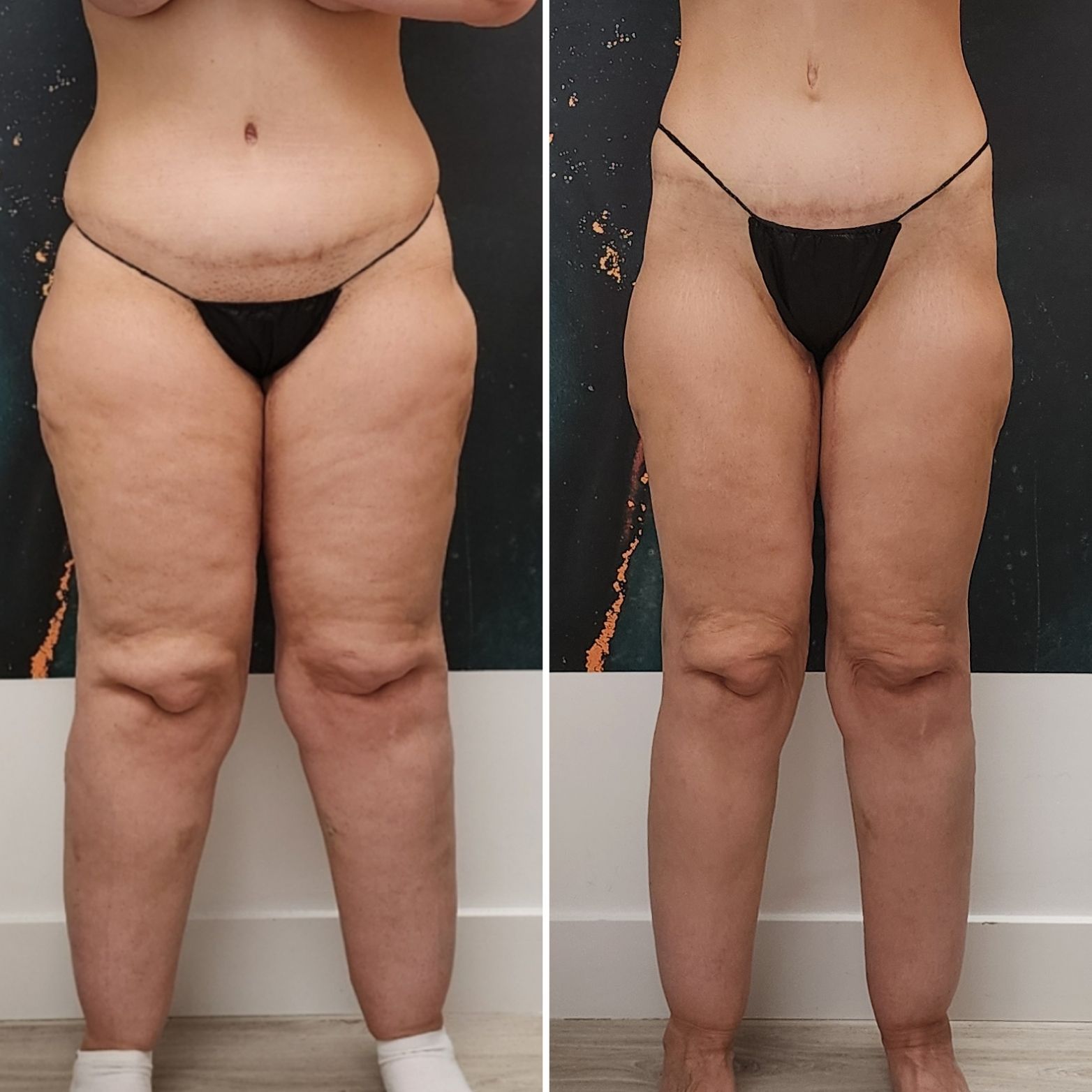 Side-by-side front view of a person in black underwear, showing a before-and-after body comparison.