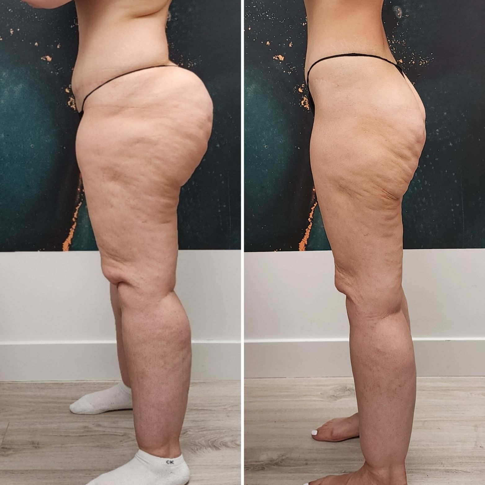 Side-by-side profile photos of the same person standing indoors, showing body shape from two angles.