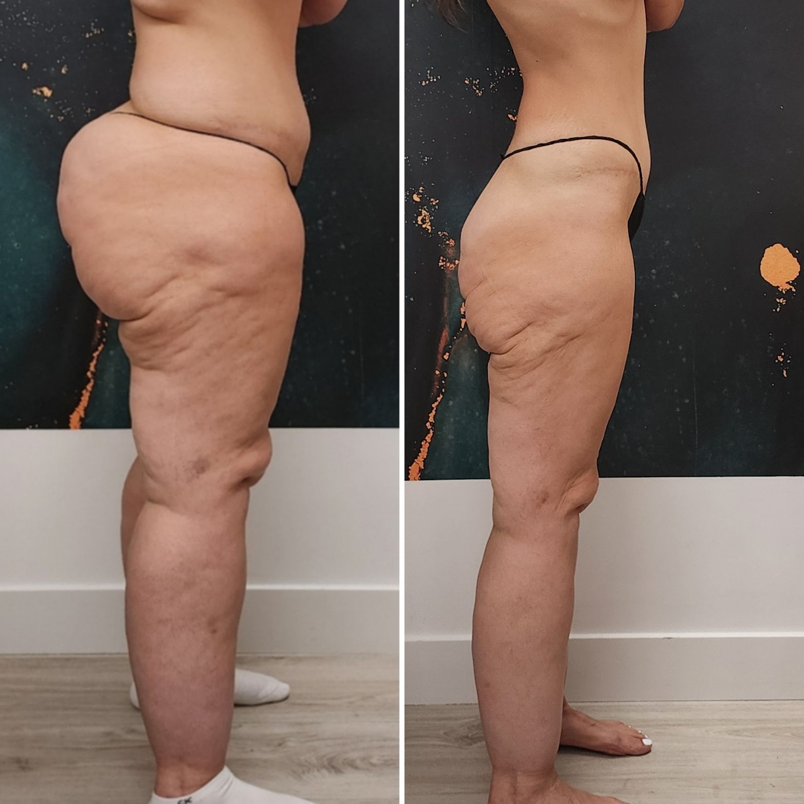Side-by-side before-and-after photos of a person’s lower body in profile, showing body shape change.
