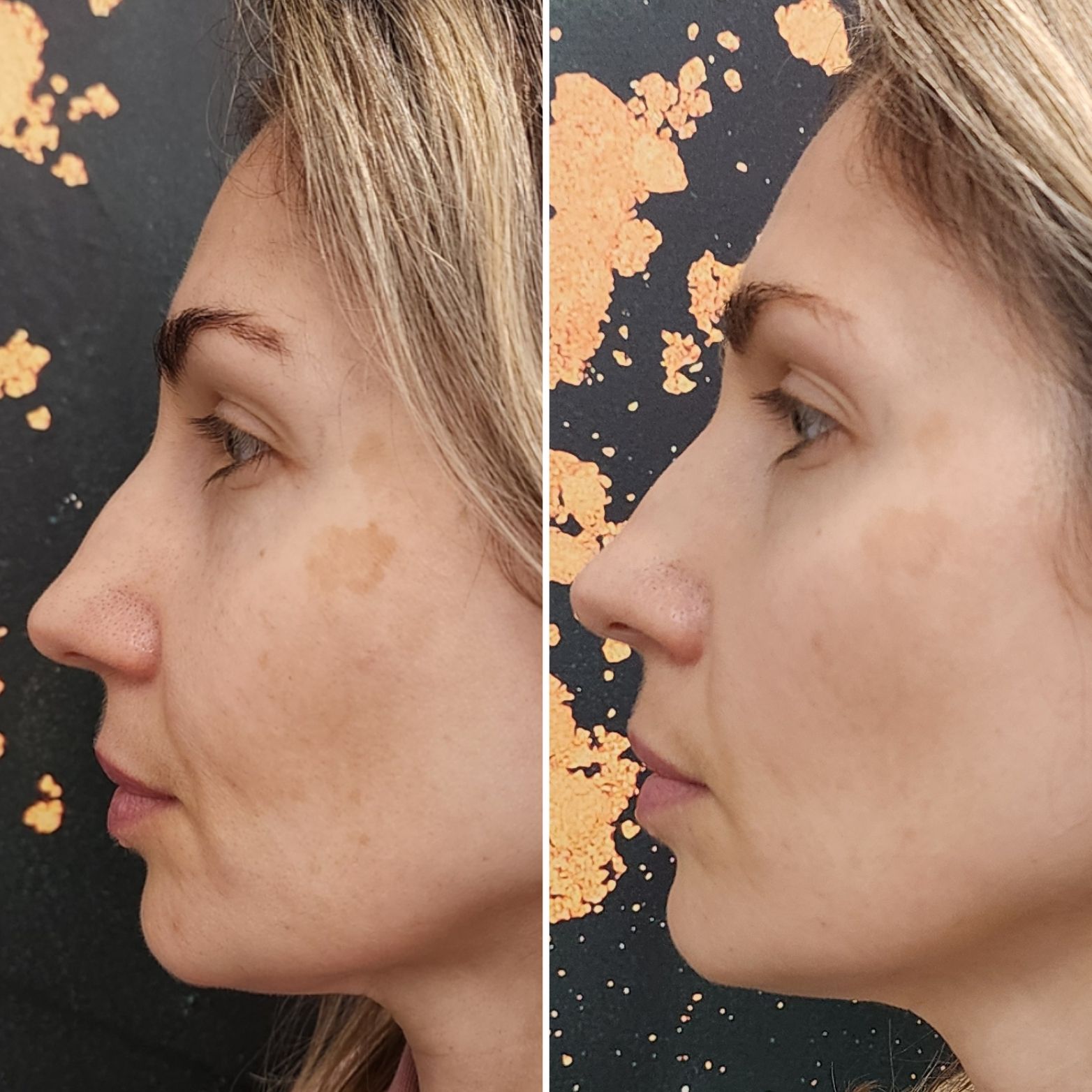 Side-by-side profile close-up of a woman’s face before and after treatment on a dark, speckled background.