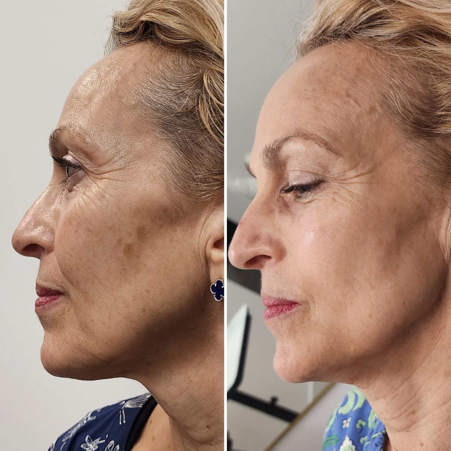 Side-by-side profile portraits of a woman before and after cosmetic treatment, showing smoother skin and softer lines