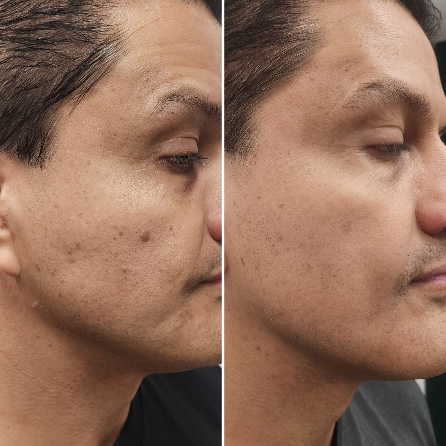 Side-by-side profile photos of a man's face, showing before-and-after skin texture