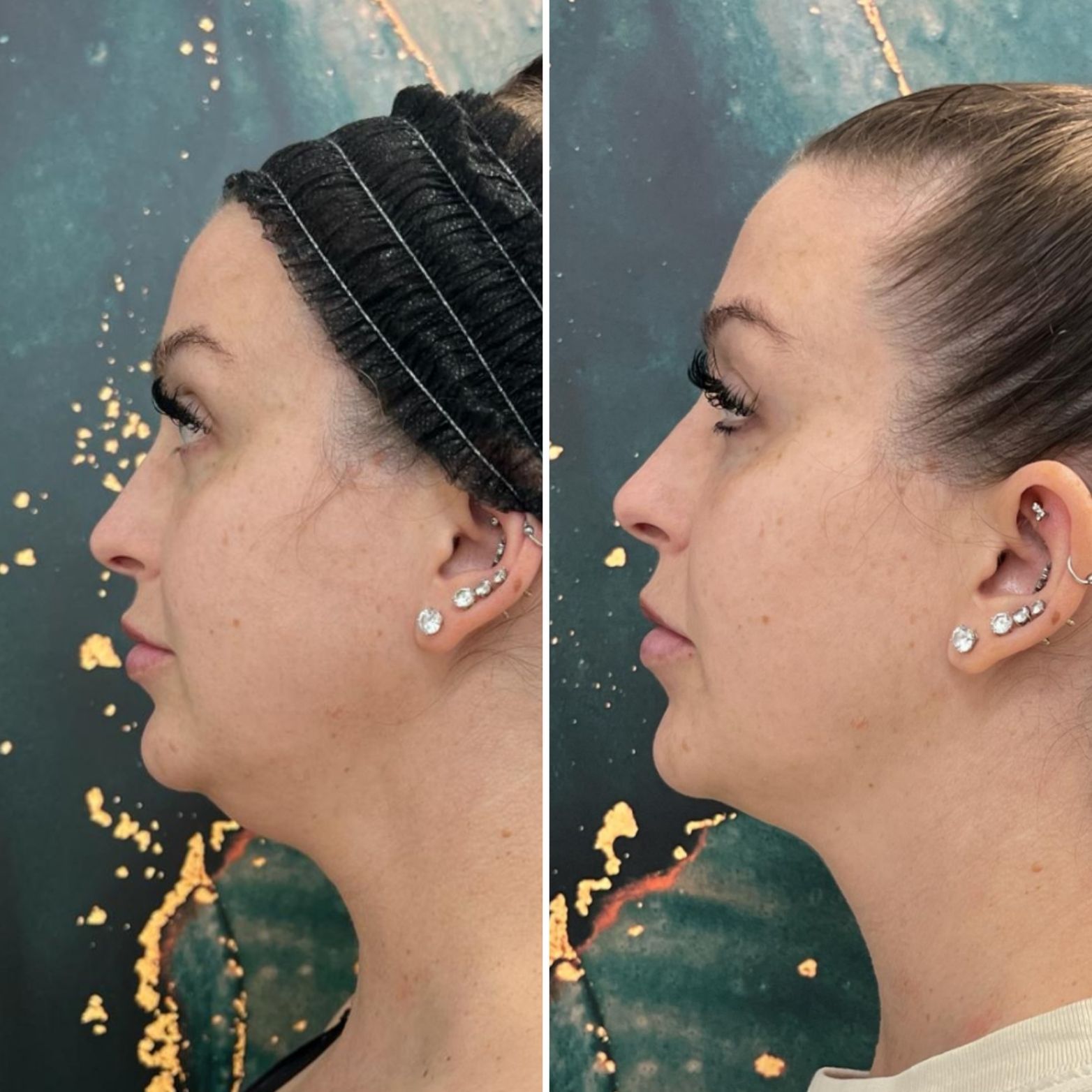 Side-by-side profile photos of a woman before and after cosmetic facial treatment.