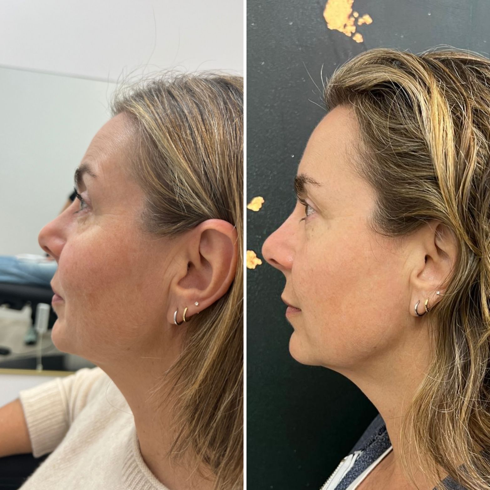 Side-by-side profile photos of the same woman before and after a hairstyle change.