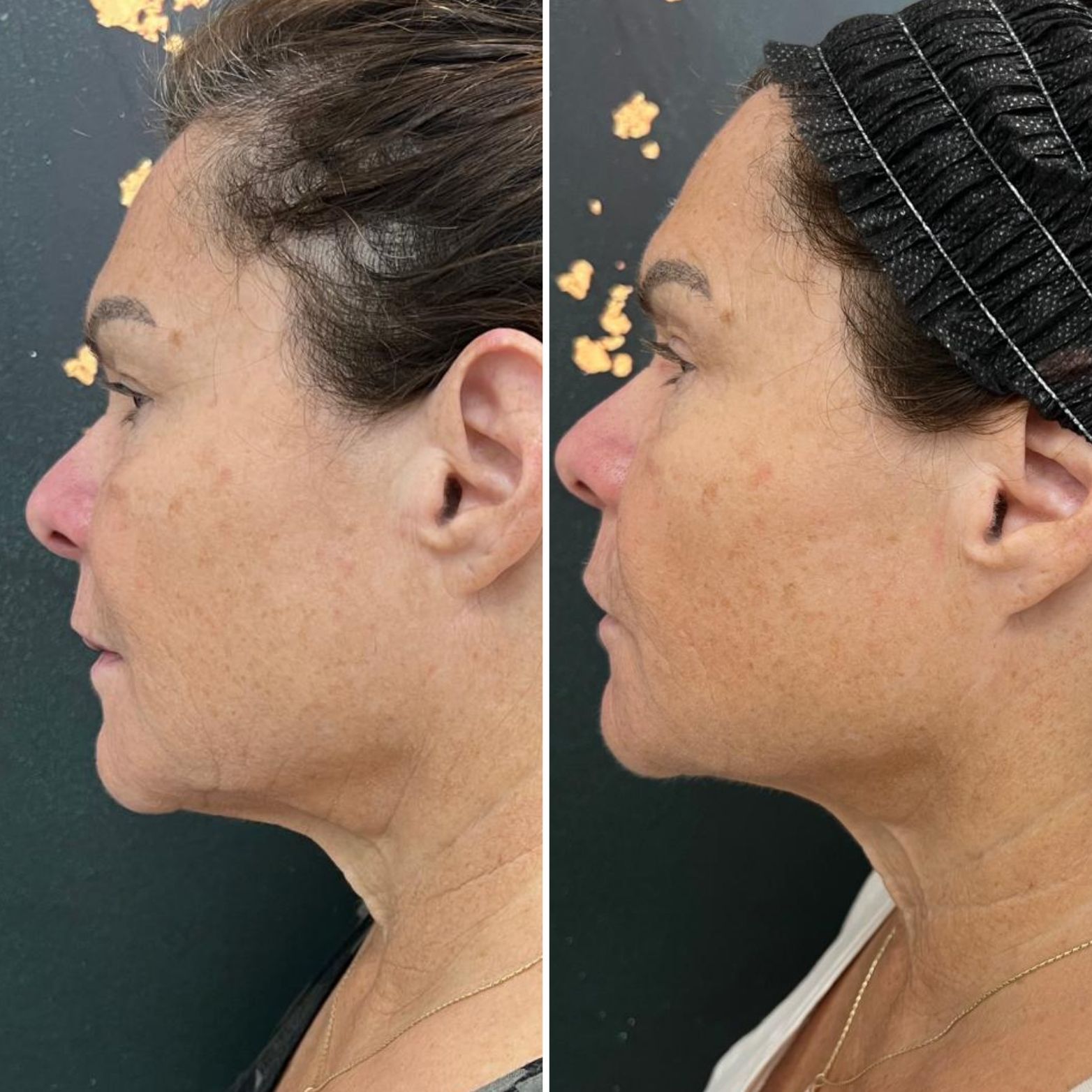 Side-by-side profile photos of a woman’s face, showing skin before and after treatment.