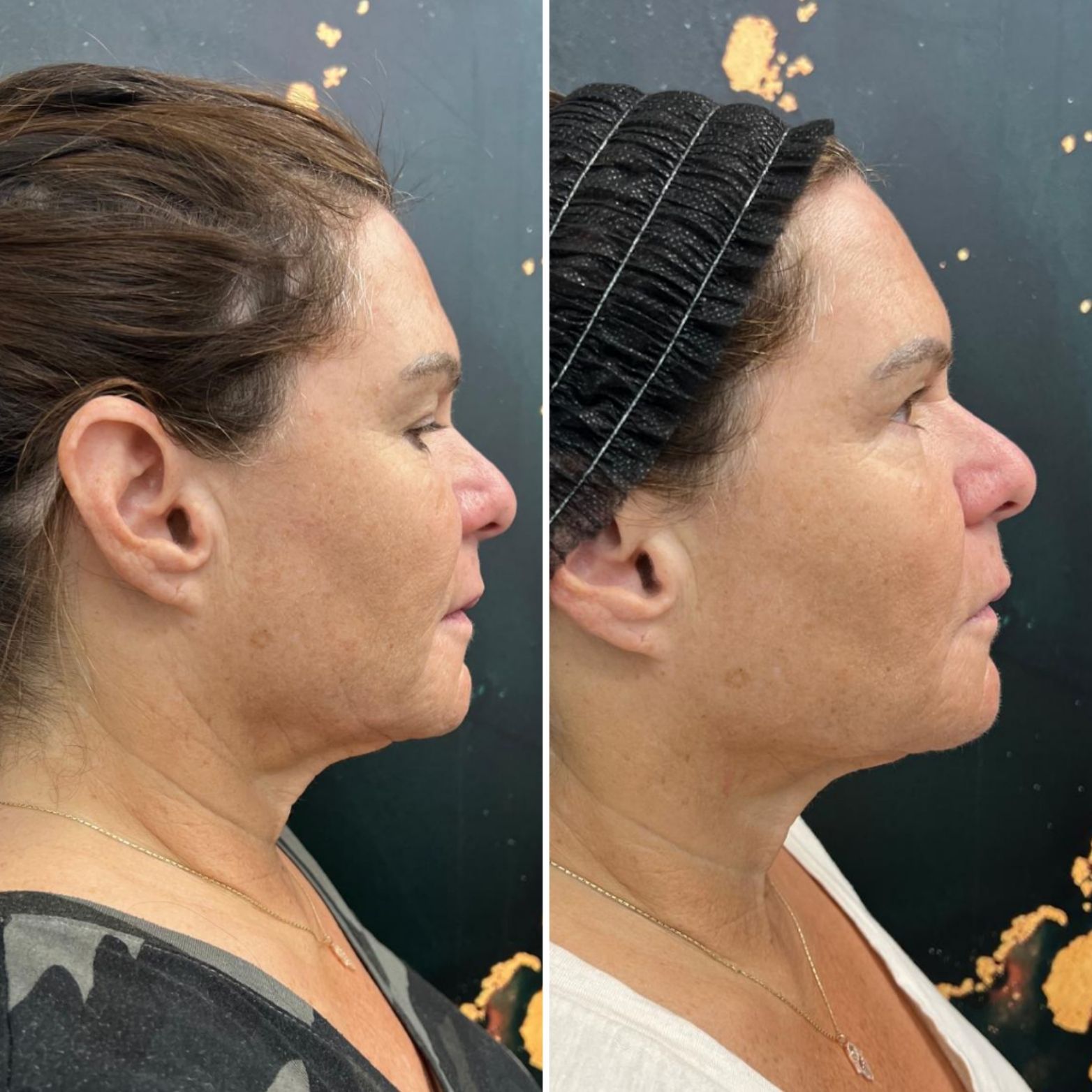 Side-by-side profile photos of a woman with a towel wrapped around her hair, showing before and after results.