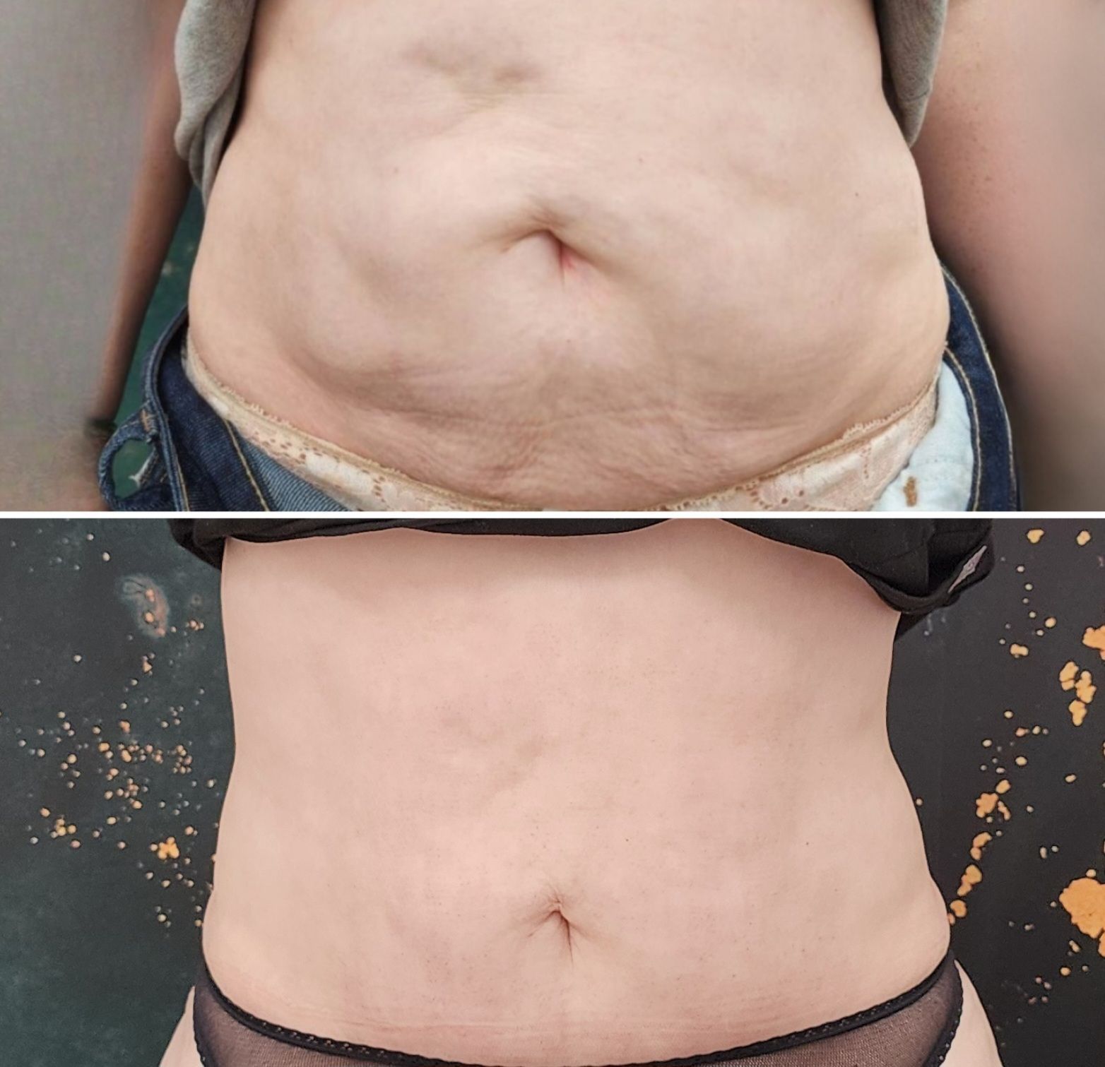 Before-and-after waist close-up showing a belly with reduced size.