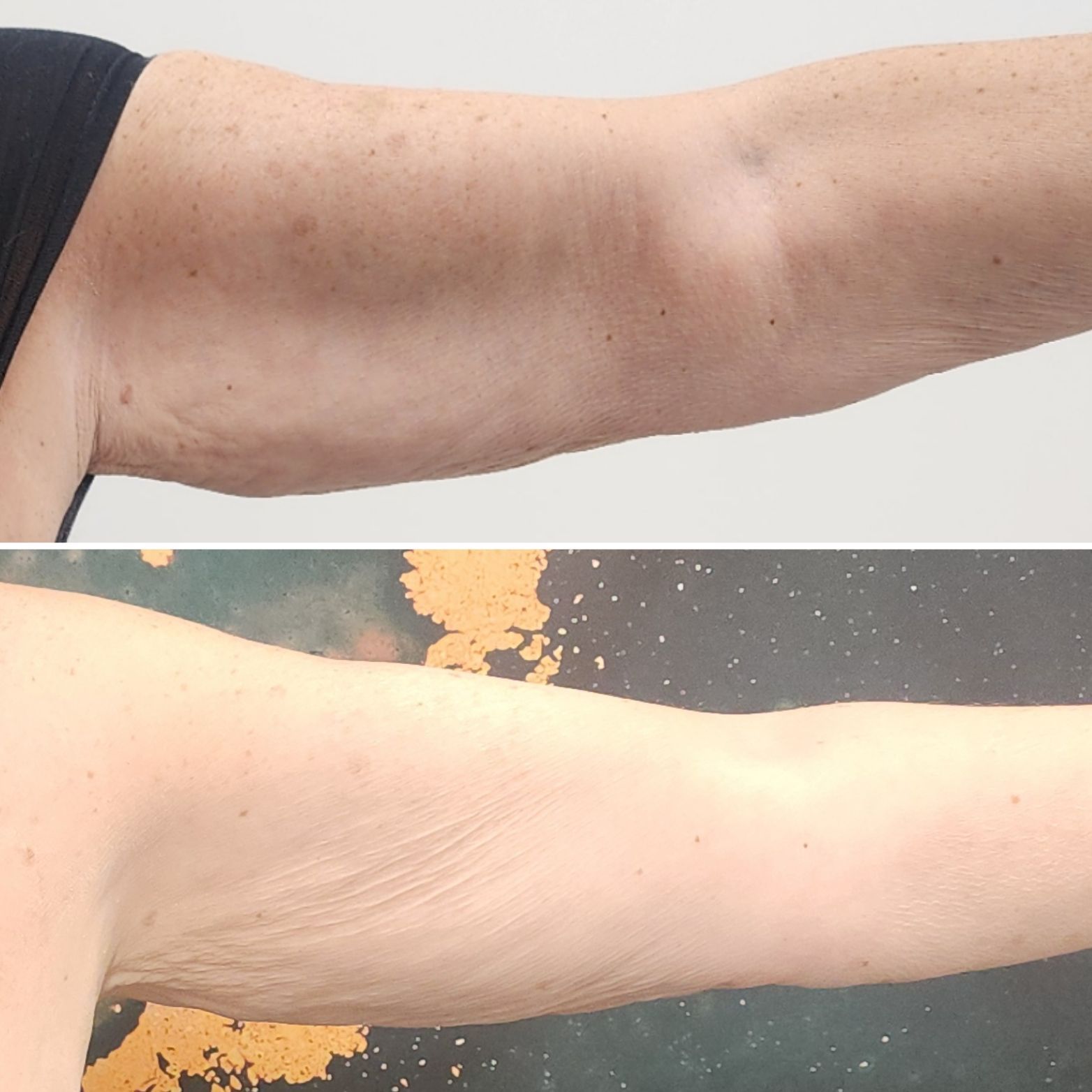 Two side-by-side close-ups of a bare upper arm, showing dark and light skin tones before and after.