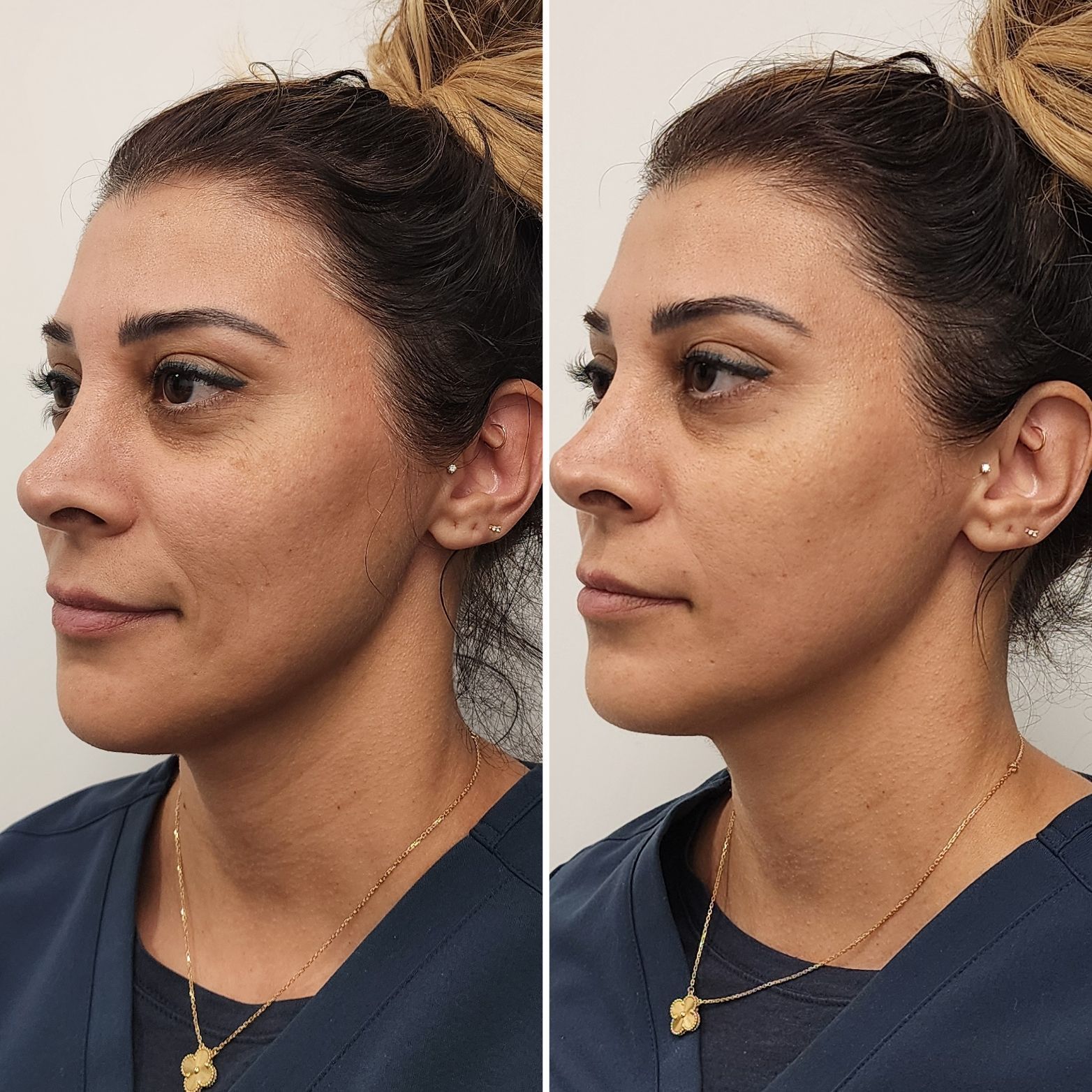 Side-by-side profile photos of a woman before and after facial treatment, facing left.