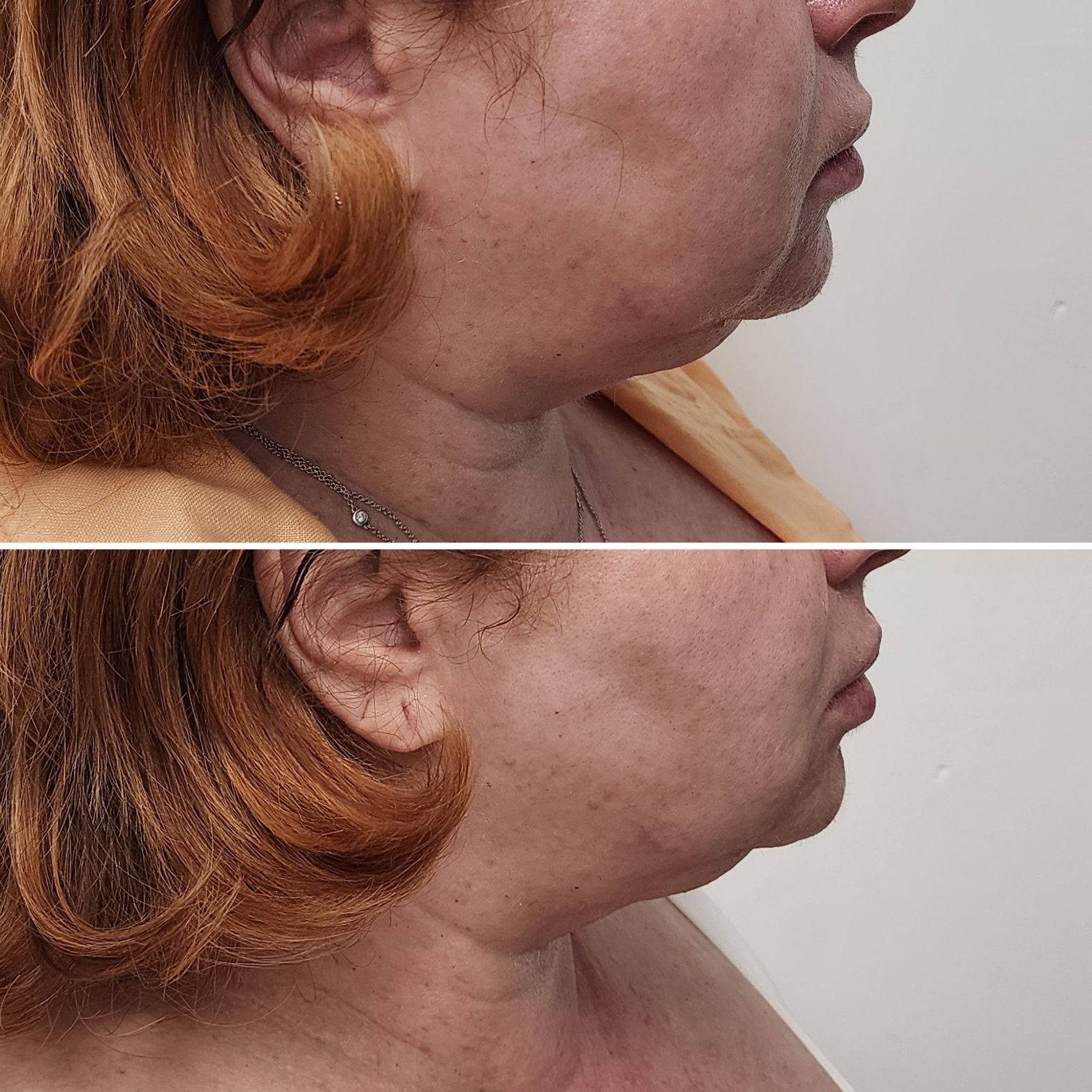 Side-by-side profile photos of a person’s neck and jawline, showing before and after treatment
