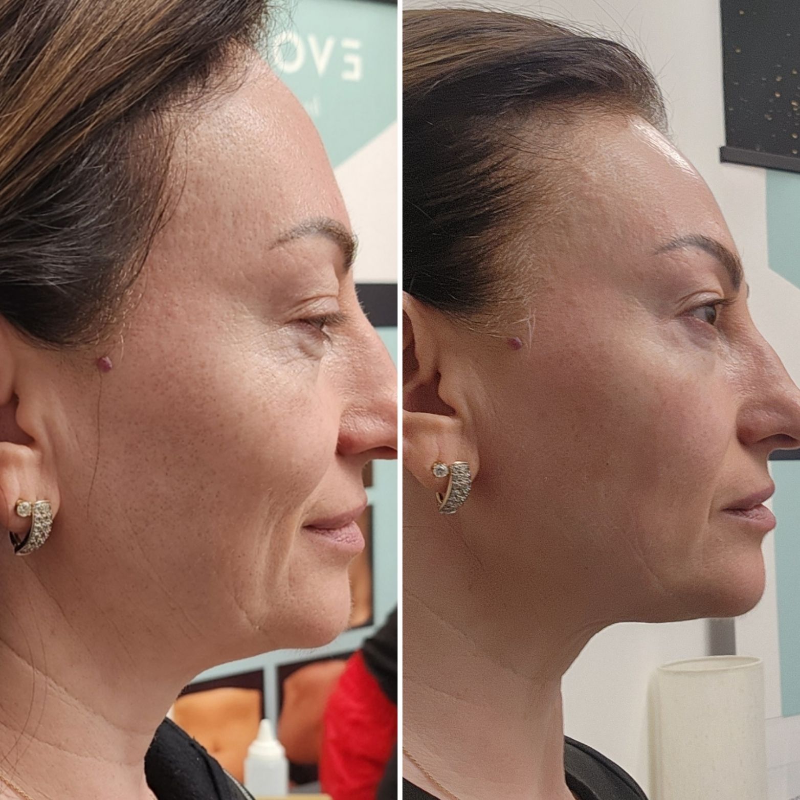 Side-by-side profile photos of a woman before and after cosmetic facial treatment.