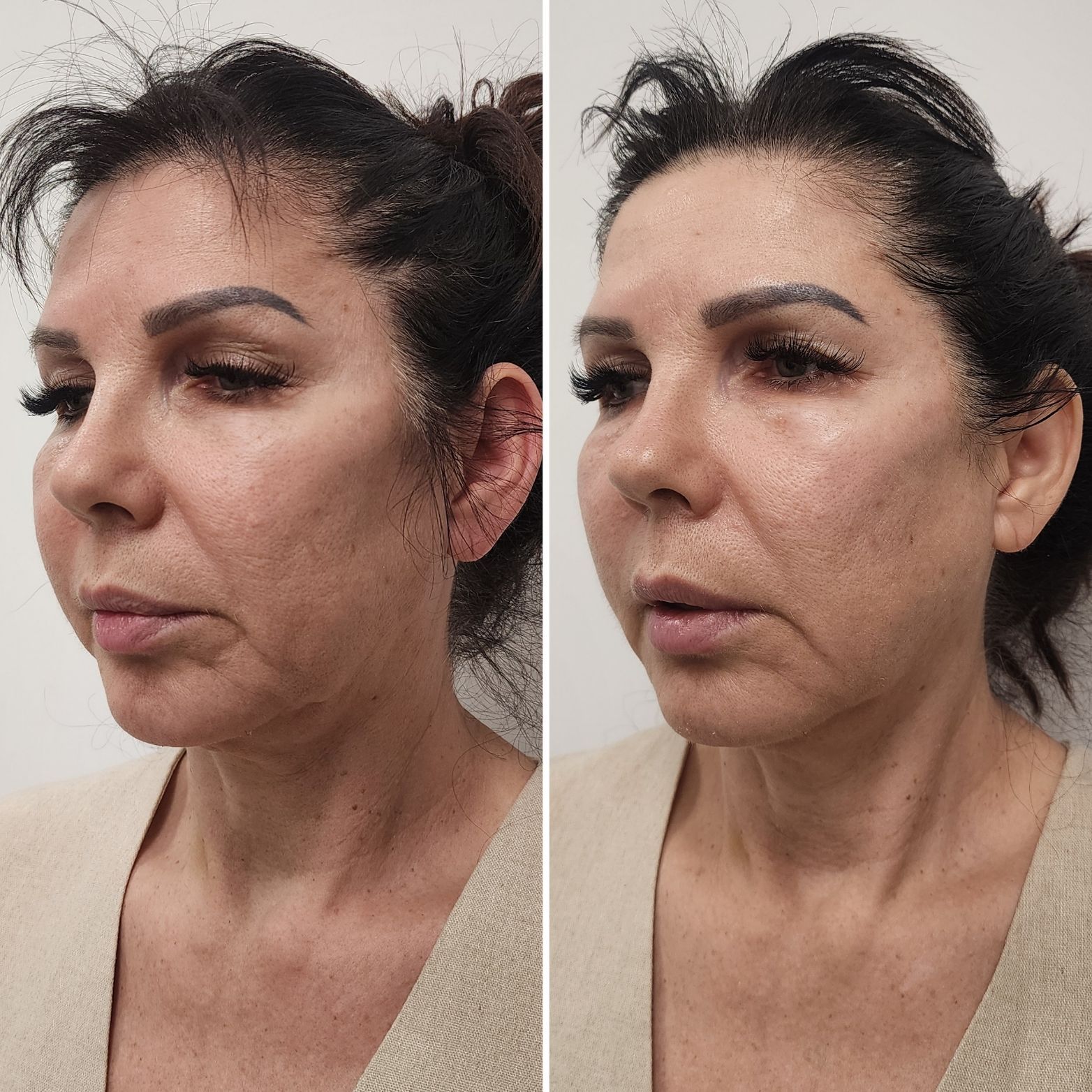 Side-by-side profile photos of a woman showing subtle facial differences, neutral background