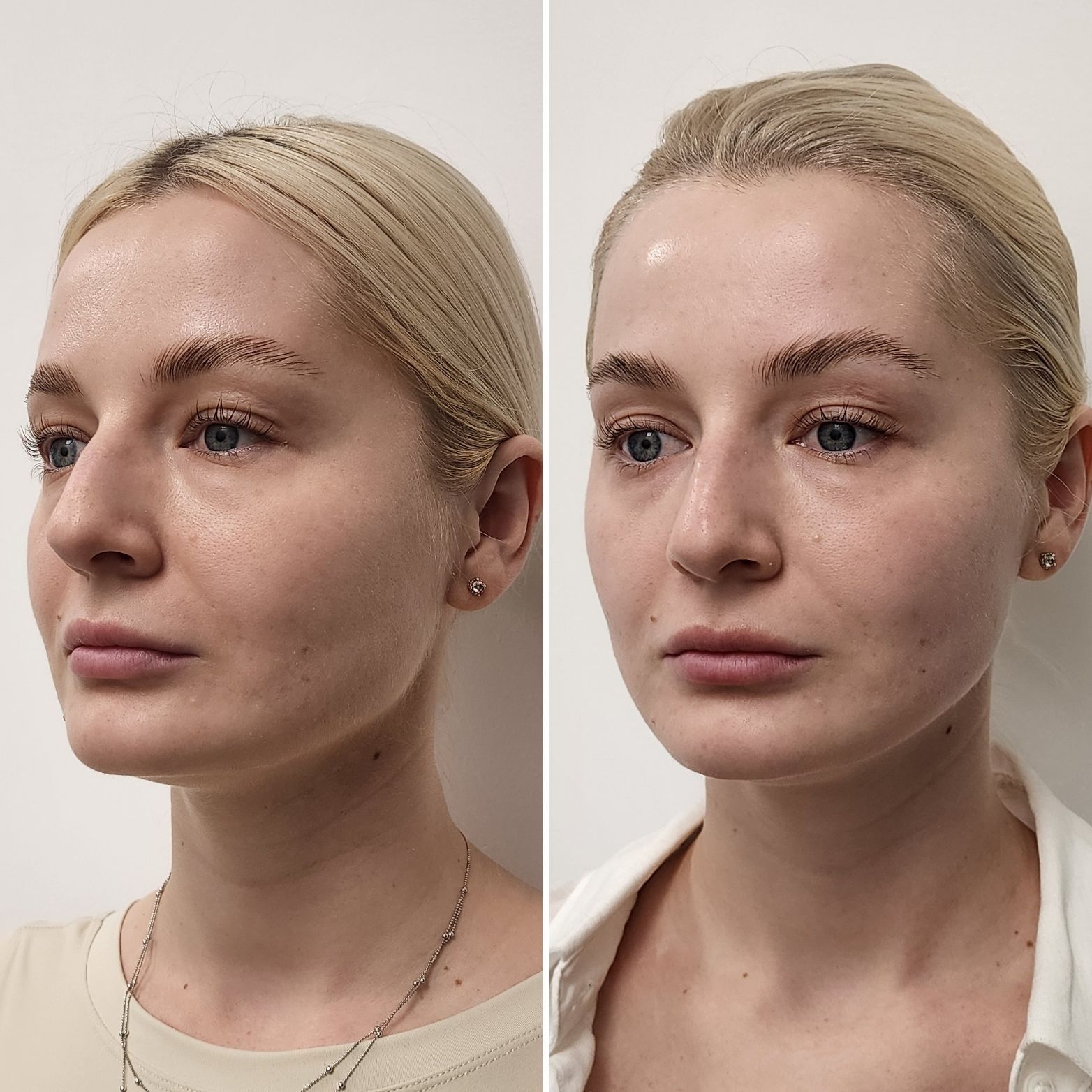 Side-by-side profile and front-view portrait of a blonde woman against a plain background