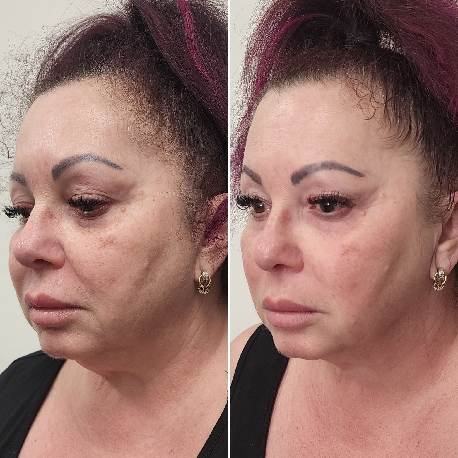 Side-by-side facial profile photos showing a woman before and after makeup or skin smoothing, with lighter skin tone on right