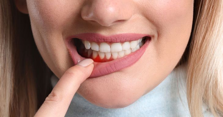 A woman is getting her teeth whitened by a dentist.