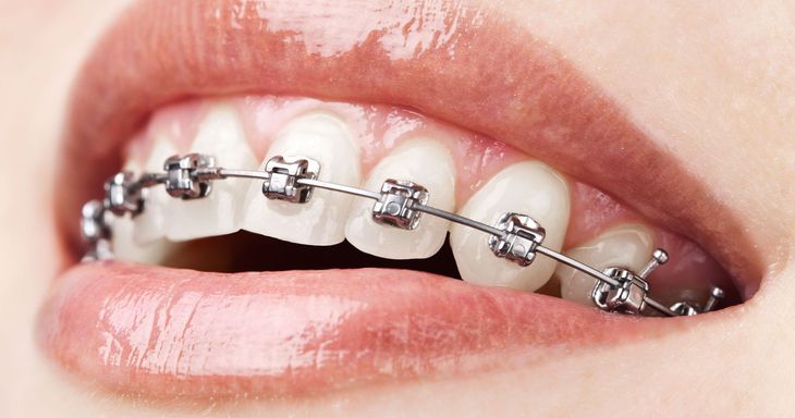 A group of tooth models and a dental implant on a table.