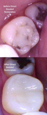 Before and after pictures - micro-composite dentistry