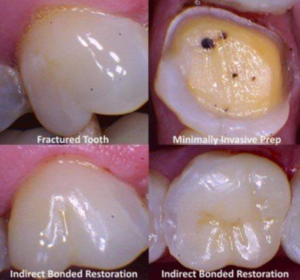 Before and after pictures - bonded indirect dentistry