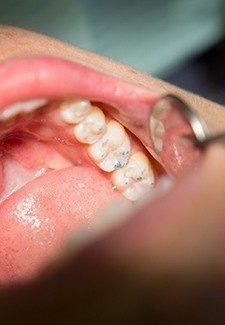 Metal-free dental restoration