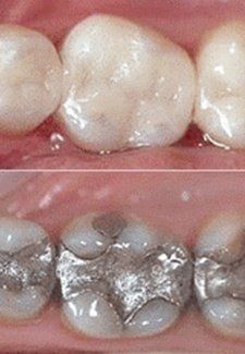 Mercury-free dentistry - before and after