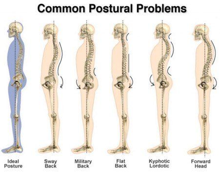 Common Postural Problems image