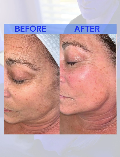 Comparison of a face before and after a treatment. The 