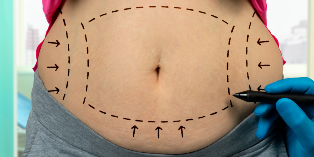 Belly with surgical markings and arrows; hand in blue glove holds pen near dotted line.