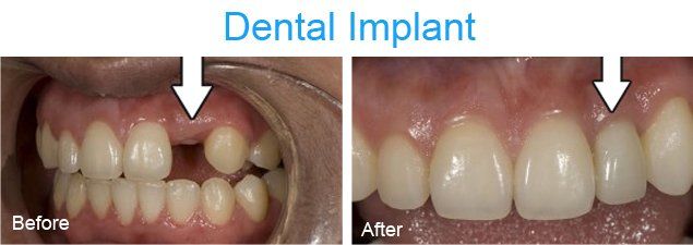 Dental implant