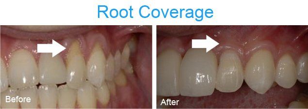 Root coverage