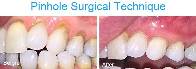 Pinhole surgical technique