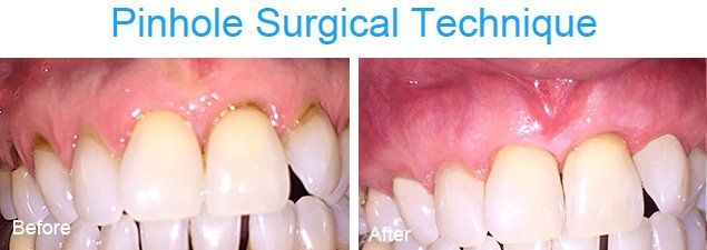 Pinhole surgical technique