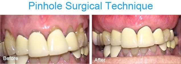 Pinhole surgical technique