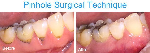 Pinhole surgical technique