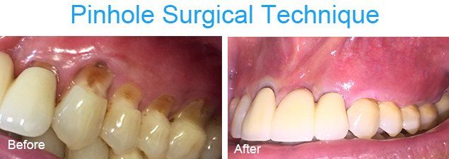 Pinhole surgical technique