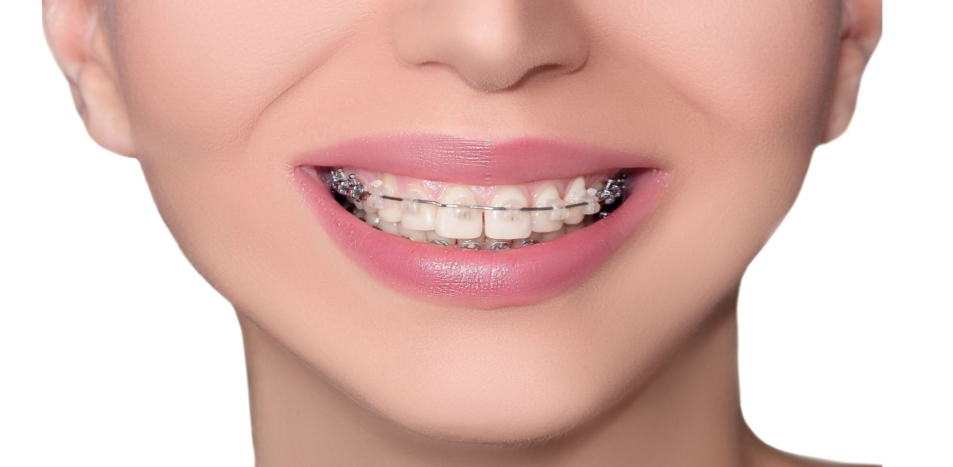 Smiling mouth with braces and shiny pink lipstick.