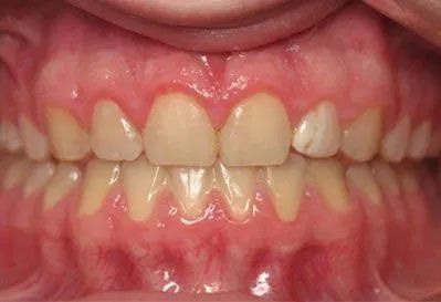 Close-up of a person's teeth. Front teeth are slightly off-white, with pink gums.