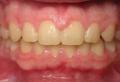 Close-up of human teeth, showing the upper and lower arches. Healthy, white teeth with pink gums.