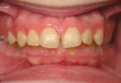 Close-up of a person's teeth, showing slight gaps and crowded arrangement; pink gums are visible.